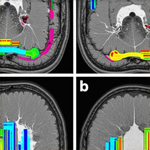Brain scan showing neuroplasticity in hypothalamic appetite centers after Semaglutide treatment